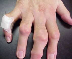 Fingers with joint deformities cause pain