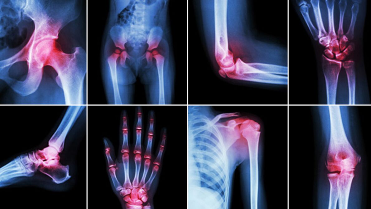 X-ray for joint pain