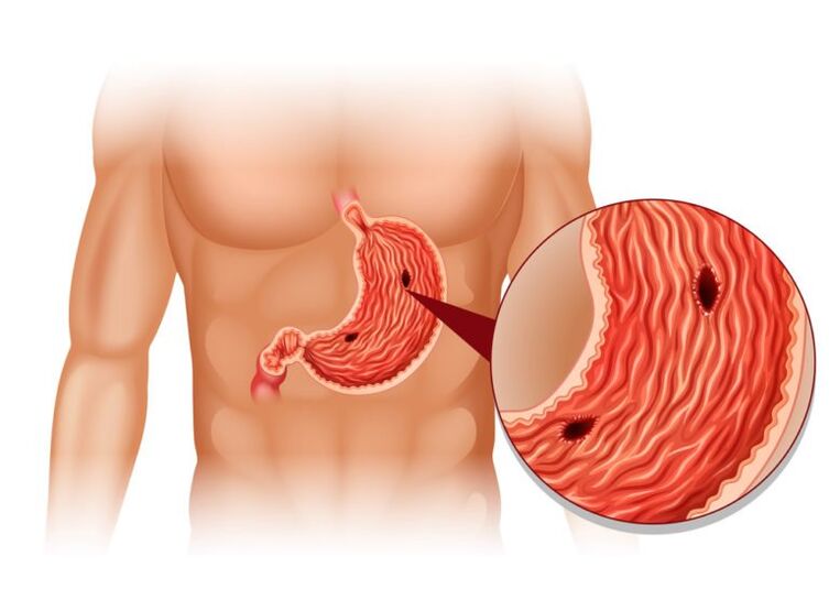 Ulcer as the cause of pain under the left shoulder blade at the back