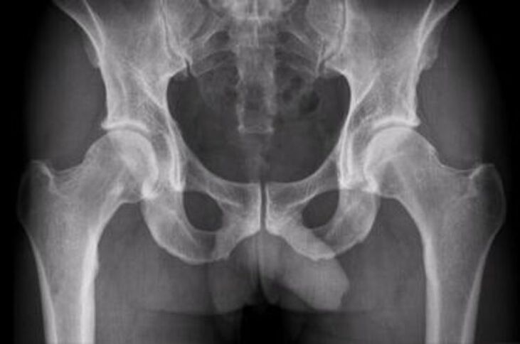 x-ray of hip joint for pain