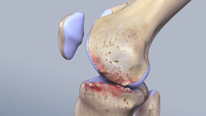 The structure of the knee joint is affected by the pathology