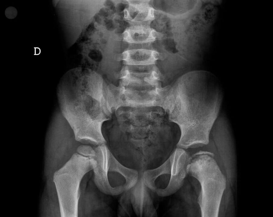 Legg-Calvé-Perthes disease – necrosis of the cartilage tissue of the femoral head