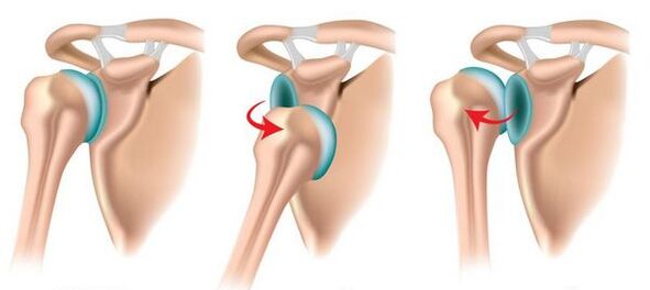 Anterior and posterior dislocation of the shoulder joint, leading to the development of arthrosis