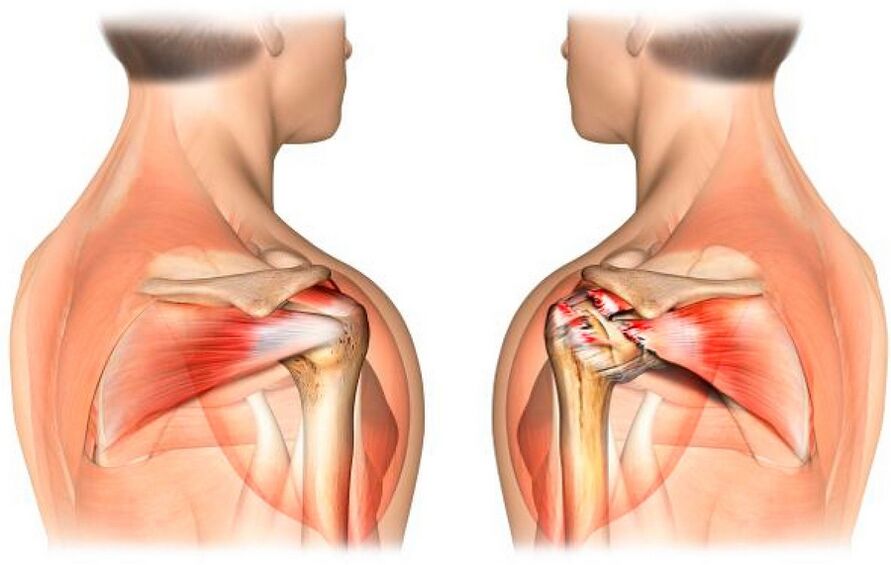 Healthy shoulder affected by osteoarthritis
