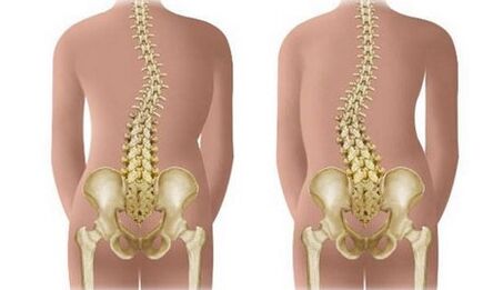 Non -resistant scoliosis