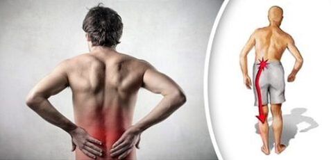 Pain syndrome with lumbar osteochondrosis exudes on the legs