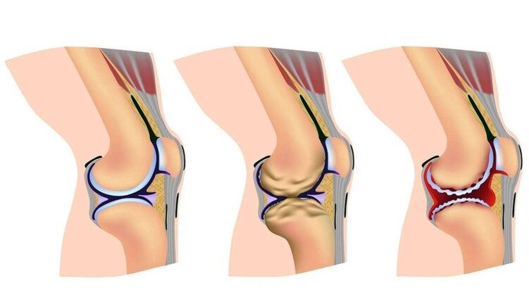 Deformation stages in the knee joint to arthrosis