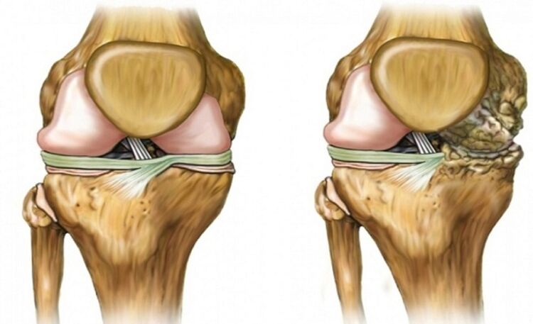 Healthy and affected by the arthrosis joint