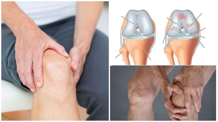 Knee pain symptom for osteoarthritis of the knee joint