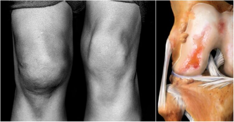 Osteoarthritis of the knee joint and the joint of the pain