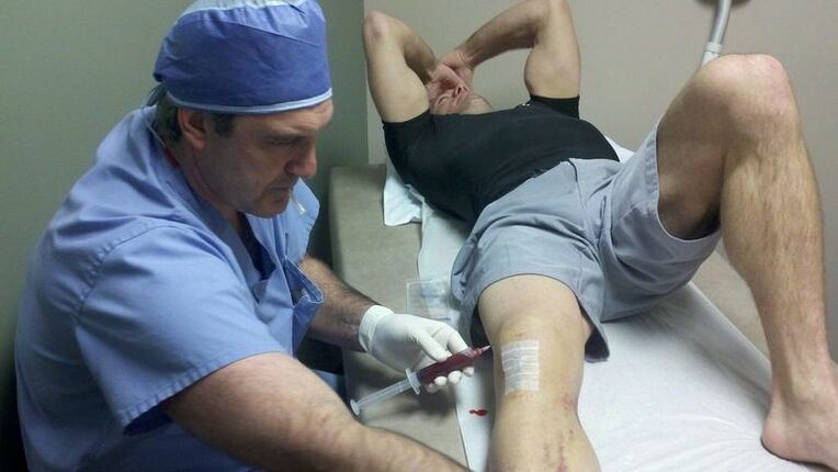 Treatment of the arthrosis of the knee joint