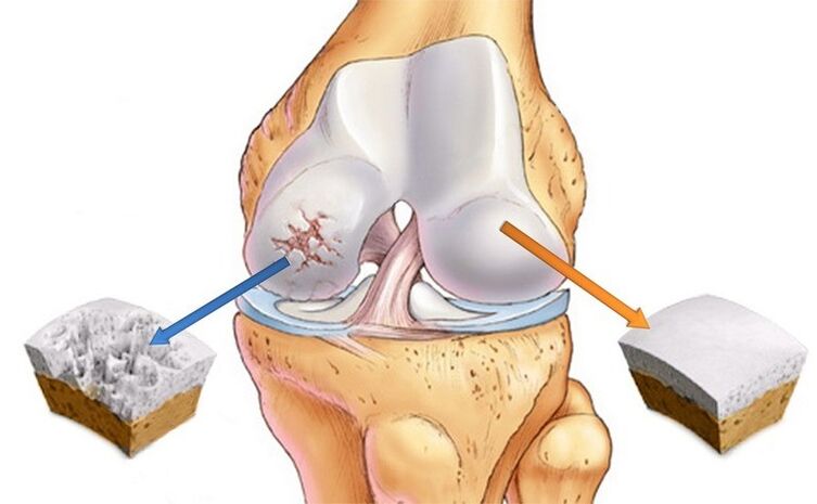 normal cartilage and osteoarthritis