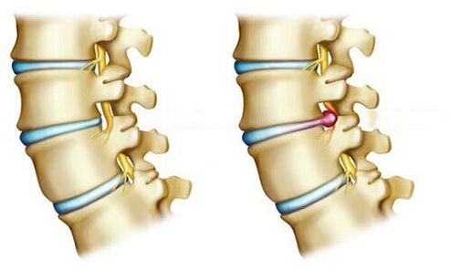 healthy intervertebral disc and herniated disc