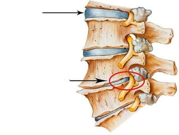 normal and damaged intervertebral disc in the spine