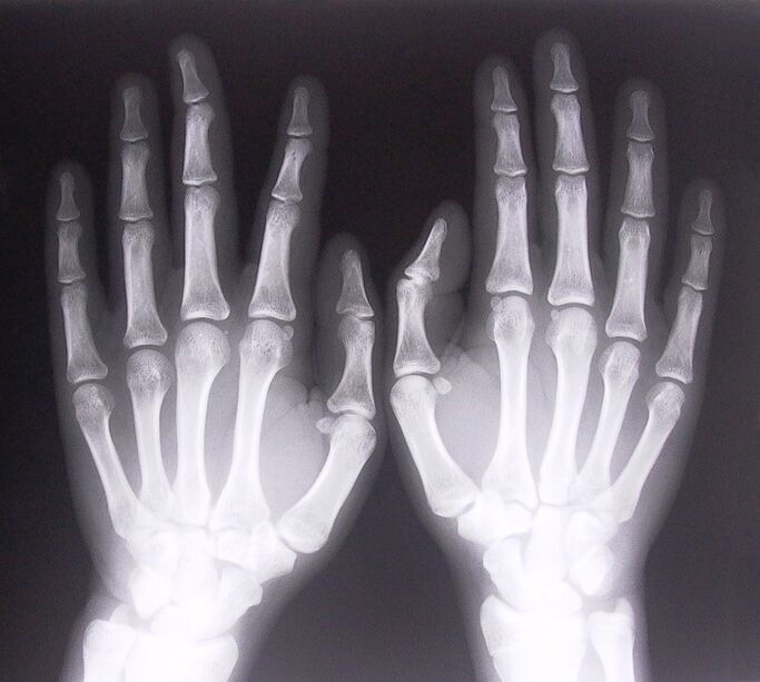 X-ray to diagnose pain in the finger joints