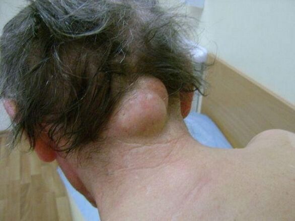 Swelling in the neck as a cause of pain