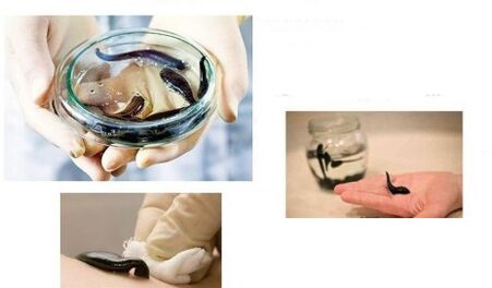 Hirudotherapy for osteoarthritis