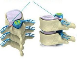 Herniated disc